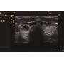 Pajzsmirigy göbök SMDR-rel
